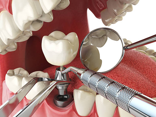 Best Emergency Wisdom Teeth Removal in Flanders, NY